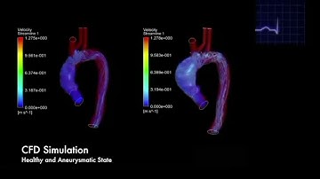 Aortic #aneurysm #digitaltwin