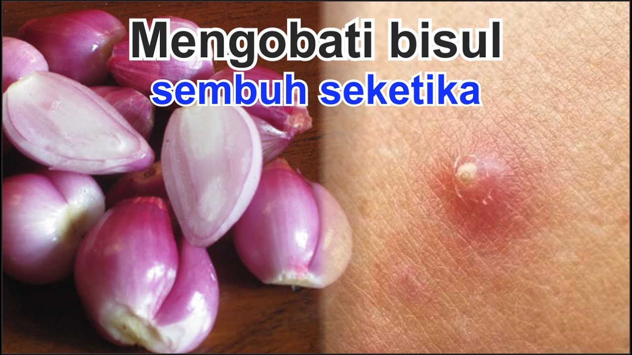 Mengobati Bisul Langsung Sembuh Seketika dengan Bawang Merah