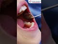 Dental Cavity: Complete Guide to Causes, Diagnosis &amp; Management | Dr. Shilpi Lal Gupta DentalSurgeon