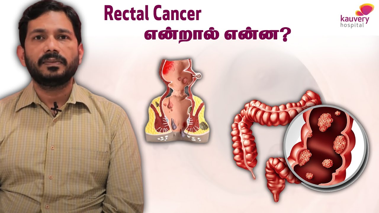 What is the Rectal Cancer?