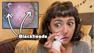 Vacuuming Our Blackheads For The First Time