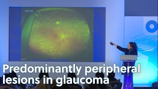 Predominently perhipheral lesions in glaucoma