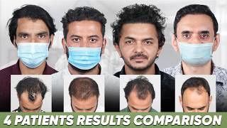 Hair Transplant in India (HX-QYYG) | Best Results & Cost of Hair Transplant in India