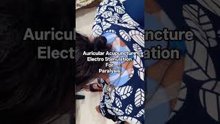Paralysis treatment with Auricular Acupuncture and Electro Stimulation Therapy