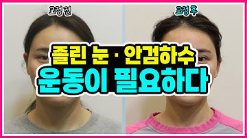 졸린 눈, 안검하수! 운동이 필요하다? 눈매 교정, 눈 커지는 운동, 짝눈 교정운동 [교정의 신, 리샘TV]