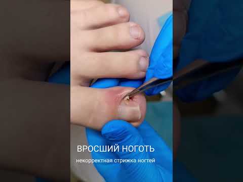 Вросший ноготь-неправильная стрижка ногтей- педикюр #аппаратныйпедикюр #подология #вросшийноготь