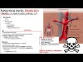 Abdominal Aortic Aneurysm (AAA) | Presentation, Risk Factors, & Signs/Symptoms