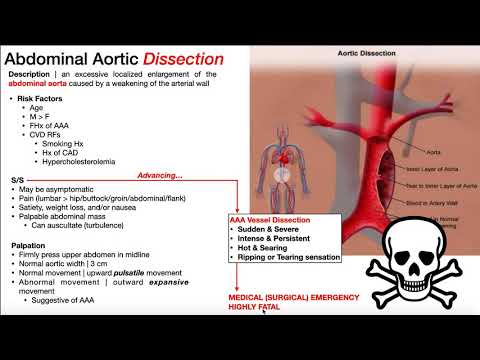 Abdominal Aortic Aneurysm (AAA) | Presentation, Risk Factors, & Signs/Symptoms
