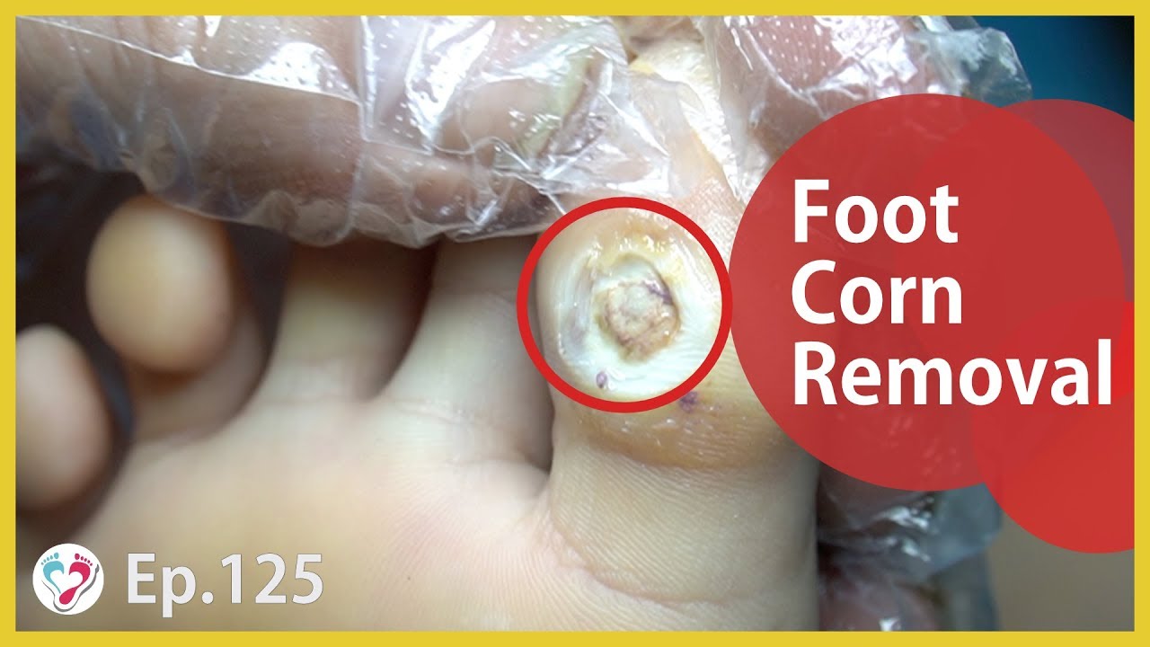 TOP MEDICAL PEDICURE Ep.125 Rear Foot Corn In Big Toe Treatment YouTube