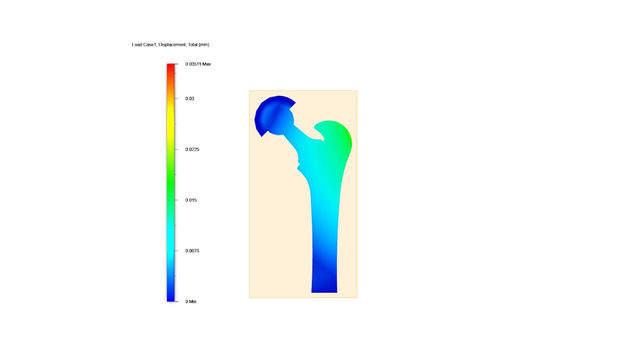 Finite Element Analysis of an Orthopedic Implant (Hip Replacement ...