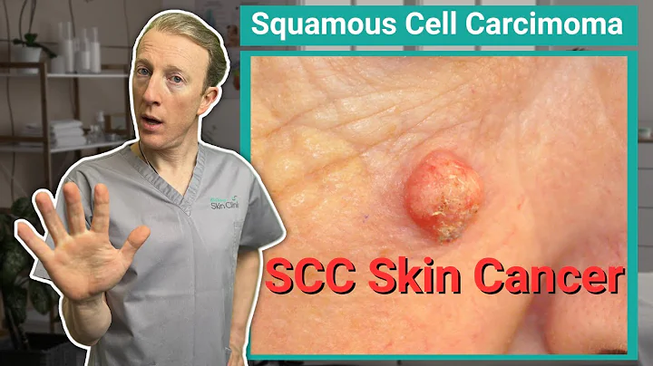 Squamous Cell Skin Cancer (SCC) : What You Need to Know for Early Detection and Treatment