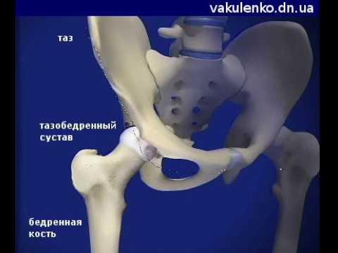 Операция по замене тазобедренного как происходит. Эндопротезирование тазобедренного сустава. Операция на тазобедренном суставе. Титановый тазобедренный сустав. Вывих тазобедренного сустава.