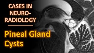 Pineal Gland Cysts: imaging findings and approach