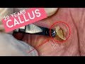 CLOSE UP | EXTREMELY SATISFYING REMOVAL 20 YEARS PAINFUL DEEP CORN CALLUS | MEDICAL PEDICURE| МОЗОЛЬ