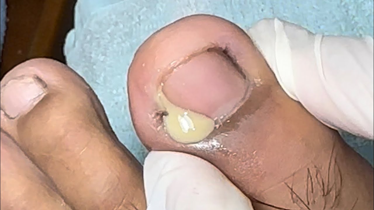 Ep_5953 Ingrown toenail removal 👣 อุ๊ย..ลูกดูสิ! ☺️ (clip from Thailand
