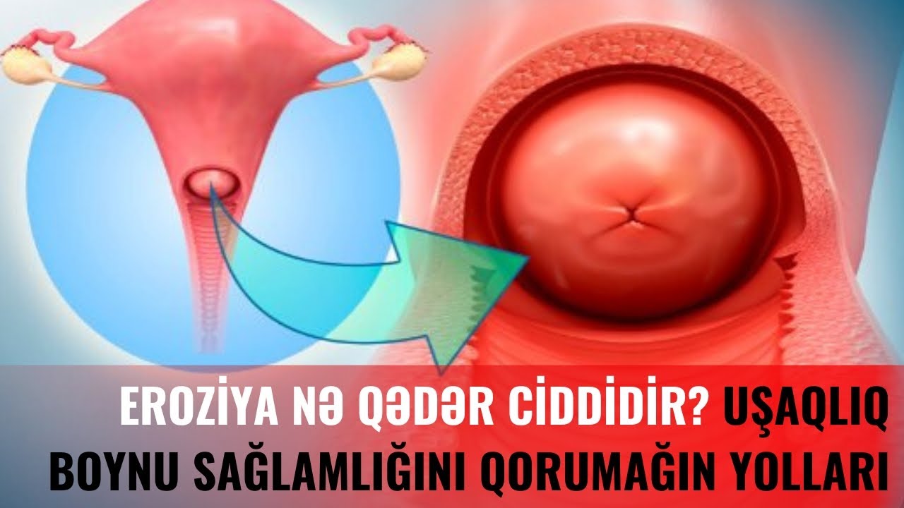 Uşaqlıq boynunda eroziya (ektropion) - Nə qədər təhlükəlidir və müalicəsi necə aparılır?