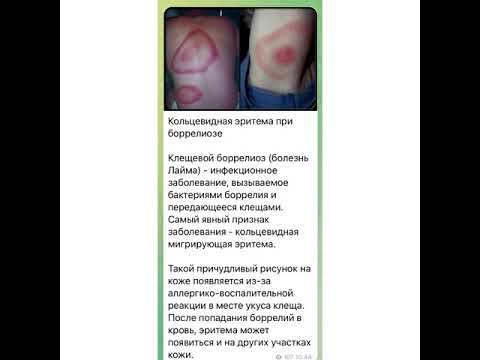 Медицина: Кольцевидная эритема при боррелиозе/04.08.21