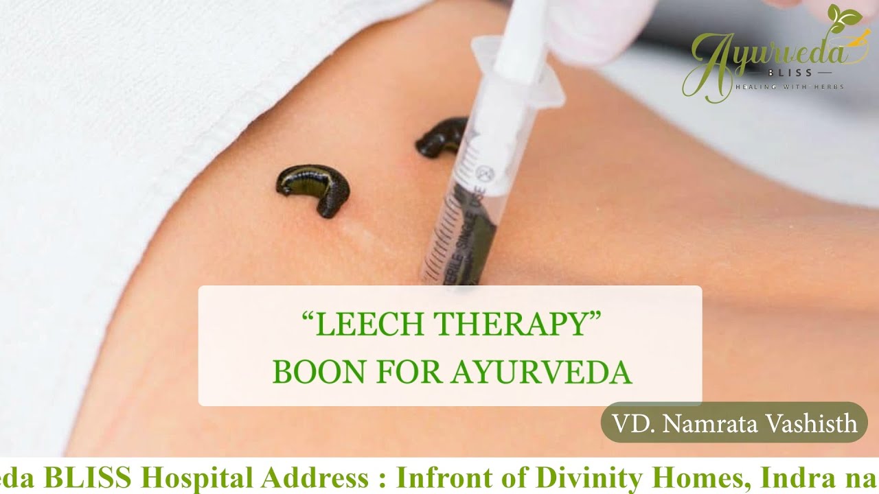Leech Therapy Bone For Ayurveda Surshut Ayurveda Bliss Kanpur