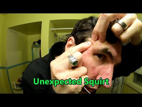 Mini Cyst Squirt | Life With Cystic Acne Documentary #
