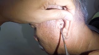 Something Stuck for Months in  Elderly Man's Ear | That's Why He Complains of Hearing Loss by Earwax Specialist 13,560 views 6 days ago 1 minute, 29 seconds