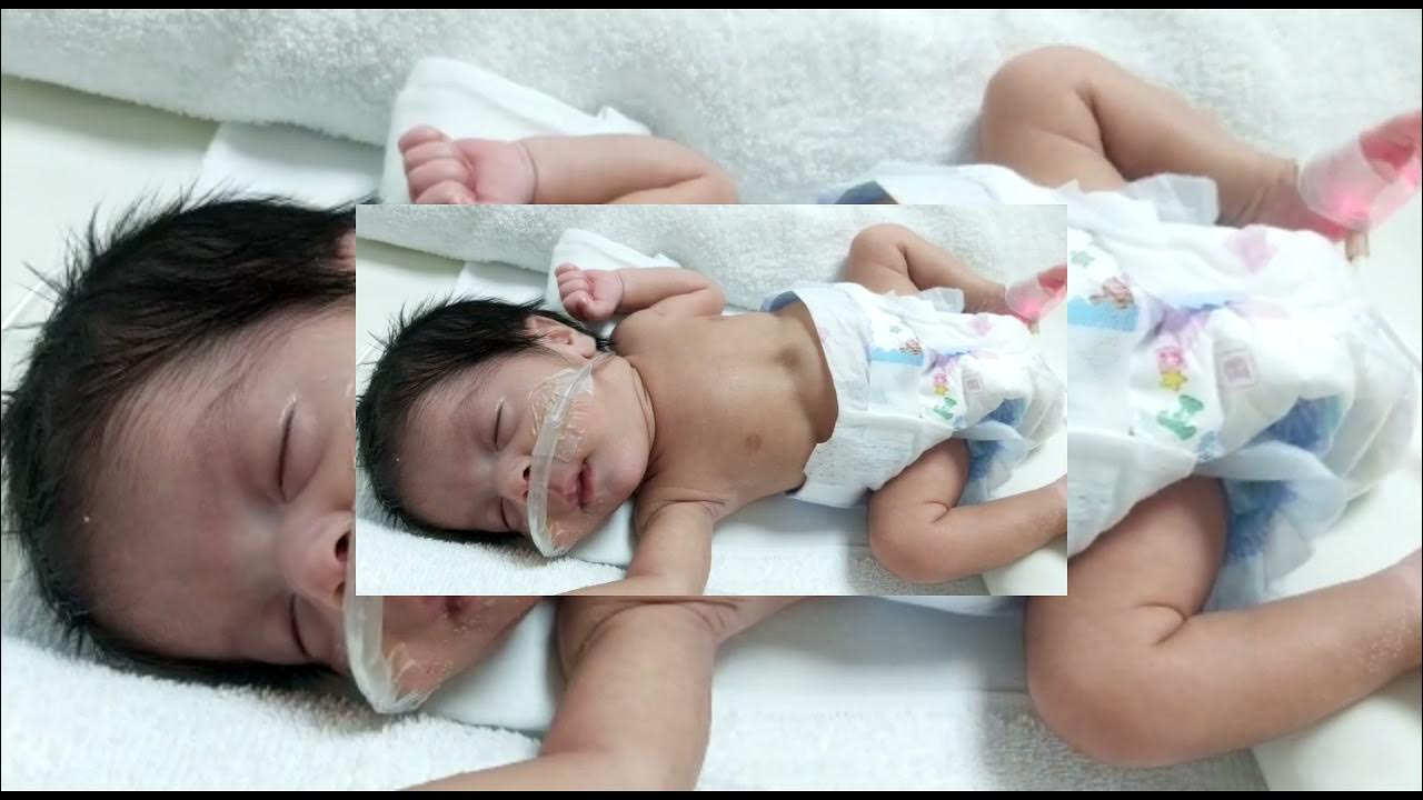 Head nodding due to severe suprastrnal and substernal subcostal