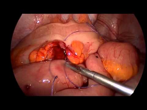 Minimally Invasive Laparoscopic Management Of Colonoscopic Perforation: When & How Primary Repair