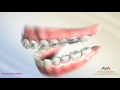 Orthodontic Treatment for Overjet (Overbite) - Wilson Bimetric Distalizing Arch Appliance