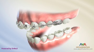 Orthodontic Treatment for Overjet (Overbite) - Wilson Bimetric Distalizing Arch Appliance