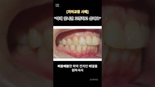 [치아교정] &quot;나이가 있는데 아래 앞니만 교정하고 싶어요&quot; 설측부분 교정치료 (전후사진 포함)#신촌유앤아이치과 #신촌교정 #신촌치과 #신촌역8번출구 #발치교정 #돌출교정