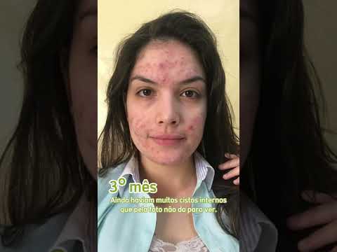 Vídeo: Como tratar acne com cúrcuma: 11 etapas (com fotos)