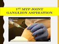 Video - ganglion aspiration