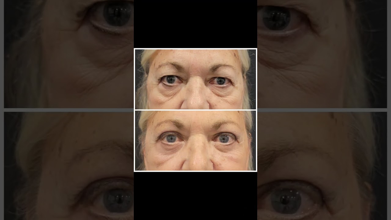 5 weeks after blepharoplasty and still healing! 