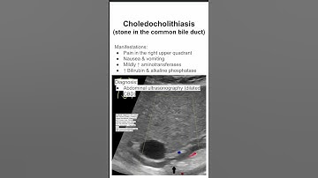Choledocholithiasis (stone in the common bile duct)