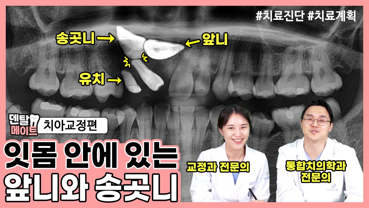 잇몸 안에 있는 매복치 교정하는 방법 [매복치를 동반한 부정교합] | 덴탈메이트 4탄 치아교정편