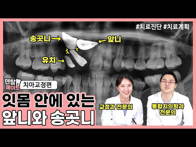 잇몸 안에 있는 매복치 교정하는 방법 [매복치를 동반한 부정교합] | 덴탈메이트 4탄 치아교정편