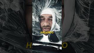 El implante capilar de @quechuchomanucho #medicalhair