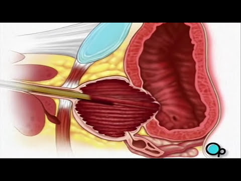 TURP Transurethral Resection Prostate Penis Surgery PreOp Patient Education