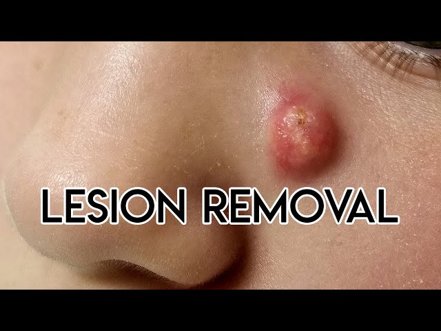 Lesion Removal