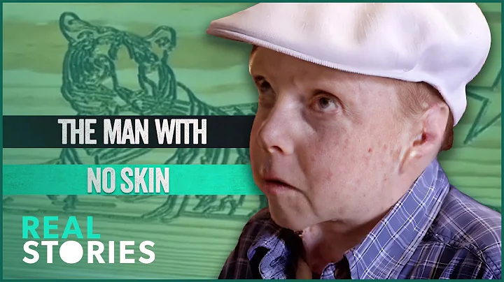 Jonny Kennedy: The Man Whose Skin Fell Off (BAFTA-AWARD WINNING DOCUMENTARY) | Real Stories - DayDayNews