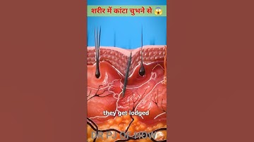 How Splinters Get Unstuck 😲#shorts #youtube