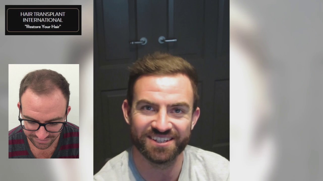 Hair Transplant International Alex Brown’s Testimonial YouTube