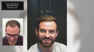 Hair Transplant International: Alex Brown’s Testimonial