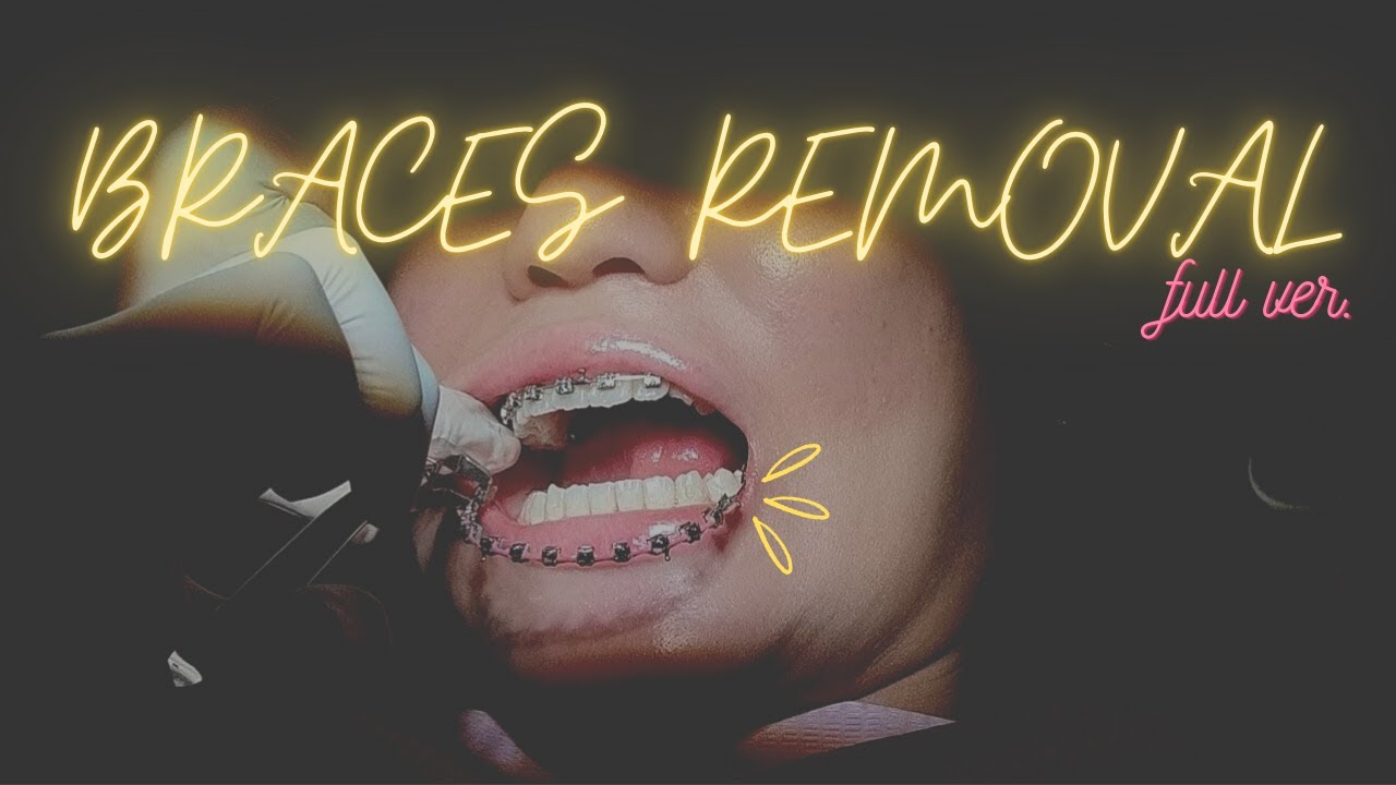 BRACES REMOVAL full version (with before & after pics) YouTube