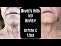 Beverly Hills MD Dermal Repair Complex—Lift and Firm Sculpting Cream—Before and After—Anti-Aging