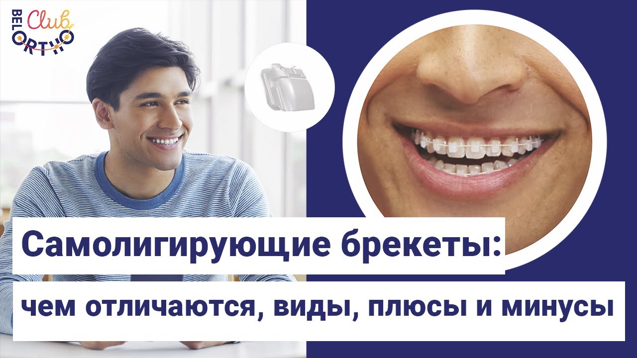 Самолигирующие брекеты – чем отличаются, виды, плюсы и минусы |БелОртоКлуб