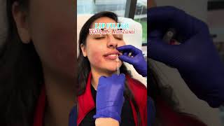 Lip Filler Transformation by Top Facial Surgeon 💉 | Virginia Medspa