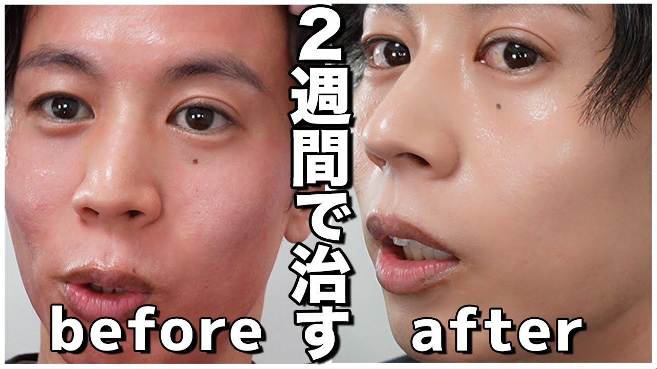 アトピー・肌荒れから最短で抜けだすためにくすり屋がやってることをお話しします