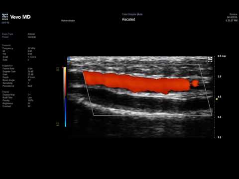 Image of Vevo MD UHF 48 - Adult Radial Artery with Colour Flow