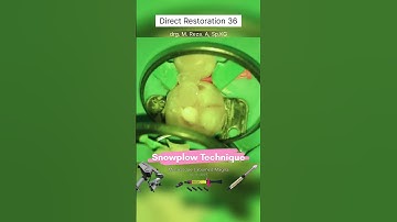 Snowplow Technique For Class II Resin Composite