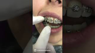 Gummy Smile ( Diş eti gülüşü) ortodontik tedavisi